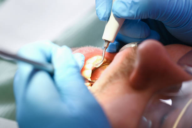 Best Urgent Care for Lost Fillings or Crowns in Hugo, MN