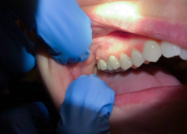 Best Emergency Denture Repair in Hugo, MN